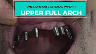 बसल इम्प्लांट्स का एक और कामयाब केसFULL MOUTH CASE OF BASAL IMPLants in just 5 days basalimplants [upl. by Taddeo]