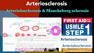 Arteriosclerosis Arteriolosclerosis vs Monckeberg sclerosis in HindiUrdu by first aid for step 1 [upl. by Armitage]