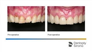 Gingival troughing with SiroLaser Blue before CEREC Upper Frontal Veneering [upl. by Monarski]