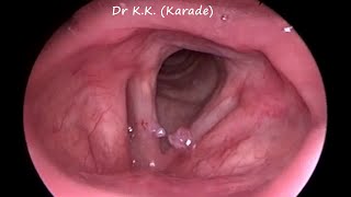 Video Laryngoscopy  How Vocal Polyp Look Like [upl. by Dan724]