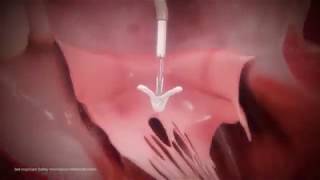 New treatment for severe mitral regurgitation by cardiologist Lee MacDonald MD MitraClip [upl. by Salena]