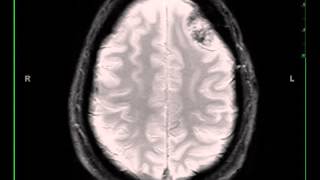 Meningioma left frontal [upl. by Aneerahs]