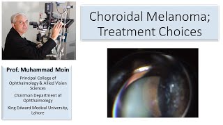 Choroidal Melanoma Treatment Choices [upl. by Teddi]