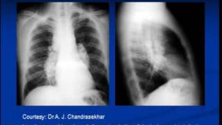 Chest xray interpretation Sarcoidosis [upl. by Anetsirk]