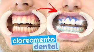 Tudo sobre meu clareamento dental dúvidas e como funciona clarear os dentes 😬💉 [upl. by Harutak]