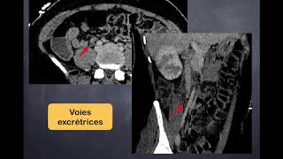 Infections urinaires  3 Pyélonéphrite aiguë  TDM [upl. by Vipul]