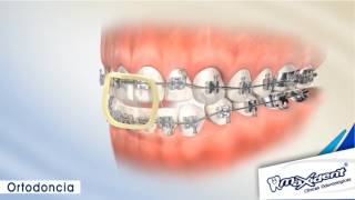 Corrección de mordida y espacios dentales quotOrtodonciaquot [upl. by Gatian]