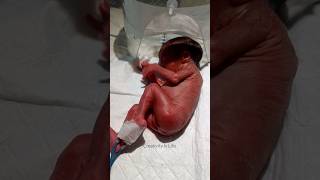 525gm Premature Baby alive shortsfeedviral [upl. by Weld]