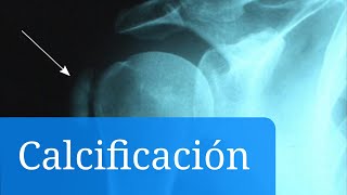 Calcificaciones Cuáles son los síntomas y el tratamiento de las complicaciones [upl. by Fifi]