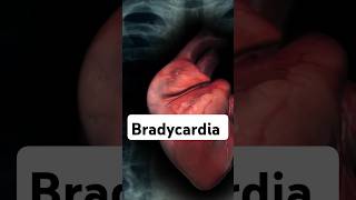 What is Bradycardia Bradycardia Heart Health [upl. by Sowell]