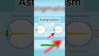 Astigmatism A simple and short explanation 👓👩🏻‍⚕️👀 astigmatism eyehealth shorts education [upl. by Chinua196]