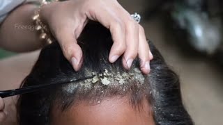 Dry scalp and lice removal technique 🤮🤮🤮🤮🤮🤮🤮🤮🤮🤮🤮🤮🤮🤮🤮🤢🤢🤢🤢🫢🫢🫢🫢🫢 [upl. by Amolap]