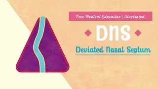 What is Deviated Nasal Septum DNS [upl. by Pernick]