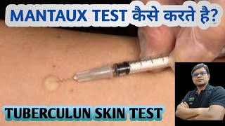 Mantoux test  TST  PPD  Tuberculin skin test  Diagnosis of TB [upl. by Andri895]