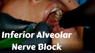 Inferior Alveolar nerve Block Injection in dentistry Landmark amp Technique in Dental Teeth Surgery [upl. by Vallie]