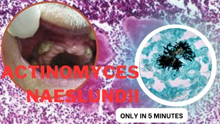 actinomyces microbiology lecture actinomyces naeslundii Easy Microbiology [upl. by Rehpotsirhc127]