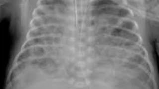 Thorax bronchopulmonary segment anatomy for medical students doctors FMG USMLE NRE exam [upl. by Odnanreh]