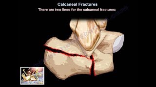 Calcaneal Fractures  Everything You Need To Know  Dr Nabil Ebraheim [upl. by Udale]