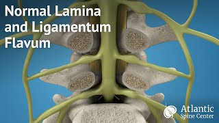 Normal Lamina and Ligamentum Flavum [upl. by Aloisia]