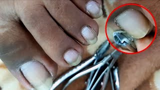 Satisfying Ingrown Toenail Removal  Dry Skin  Pedicure 122 [upl. by Kessler523]