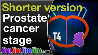 Prostate cancer stage in advanced prostate cancer [upl. by Aidin]