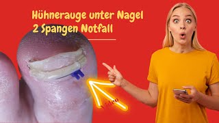 HÃ¼hnerauge unter dem Nagel 2 Spangen im Notfall [upl. by Atilahs]