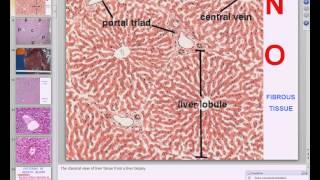 Medical School Pathology 2013 Season Session 29 GIIII Liver and Pancreas [upl. by Quince]