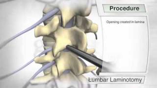 Lumbar Laminotomy Procedure [upl. by Abbey]