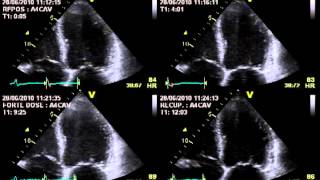 TRUE SEVERE AORTIC STENOSIS  STRESS ECHOCARDIOGRAPHY cardiac ultrasound [upl. by Kenon]