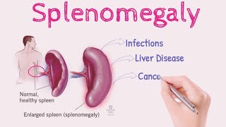 Splenomegaly OR Enlarged Spleen  Sign and Symptoms  Causes  Risk Factors  Treatment [upl. by Otrebogad172]