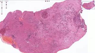 Metastasis of Pancreatic Adenocarcinoma to the Liver  Histopathology [upl. by Hareema]