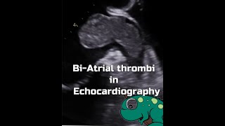 Biatrial thrombi [upl. by Orteip]