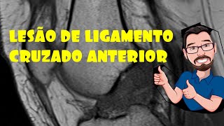 RUPTURA DE LIGAMENTO CRUZADO ANTERIOR RM [upl. by Elbon]