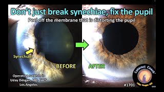 CataractCoach™1701 dont just break synechiae fix the pupil [upl. by Eyt]