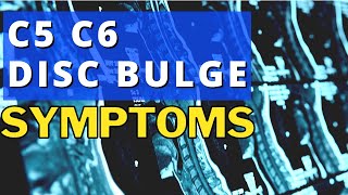 What Are The Symptoms Of A Bulging Disc In The Neck C5 C6 Disc Bulge Symptoms  Dr Walter Salubro [upl. by Shea]