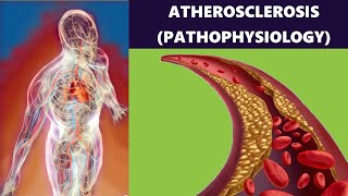 Atherosclerosis – Artery Disease Plaque Formation Risk Factors and Prevention Pathophysiology [upl. by Asira]