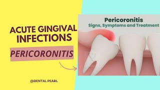 ACUTE GINGIVAL INFECTION PERICORONITIS [upl. by Eirollam]