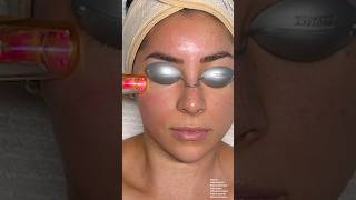 ASMR Facial Laser Treatment on Jeanine Amapola [upl. by Aihtniroc834]