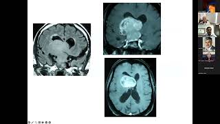 Surgical Strategy for Large Pituitary Tumors  Professor Atul Goel [upl. by Rosner46]