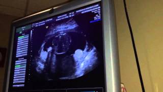 20 Week Ultrasound Gender amp Placenta Previa [upl. by Huntingdon]