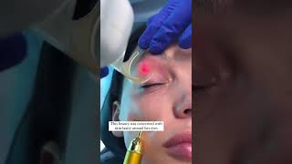 Co2 Laser Skin Resurfacing for Eyelids  Skin Tightening [upl. by Grefer555]