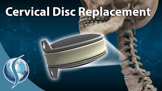 Cervical Disc Replacement [upl. by Aldwon891]