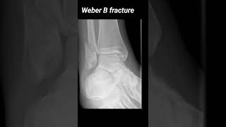 Oblique distal fibular fracture with lateral displacement of the distal fracture fragment xray [upl. by Mignonne]