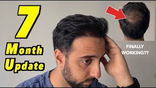 7 Month 2nd Hair Transplant Update  4000 GRAFTS FUE  ITS WORKING [upl. by Brote]