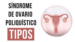 ¿Por qué padezco Síndrome de Ovario Poliquístico SOP 😨 [upl. by Ainival]