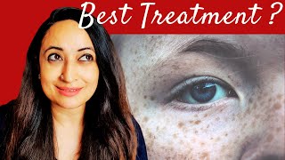 Full Guide to Freckles Treatment At Home Lasers Lightening creams DIYs for Removing Freckles [upl. by Nnep]