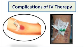 Complications of IV Therapy [upl. by Malan]