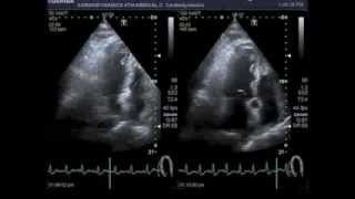 Bicycle stress echocardiography [upl. by Adarbil]