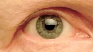 My Right Pupil Exhibiting Hippus  Pupillary Athetosis [upl. by Ruthven]