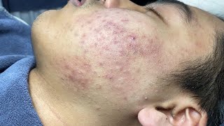 ACNE TREATMENT VU QUYNH MI Blackheads On Boy Face 2024 [upl. by Kerge538]